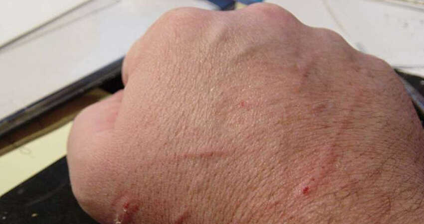 Cat bites in hand